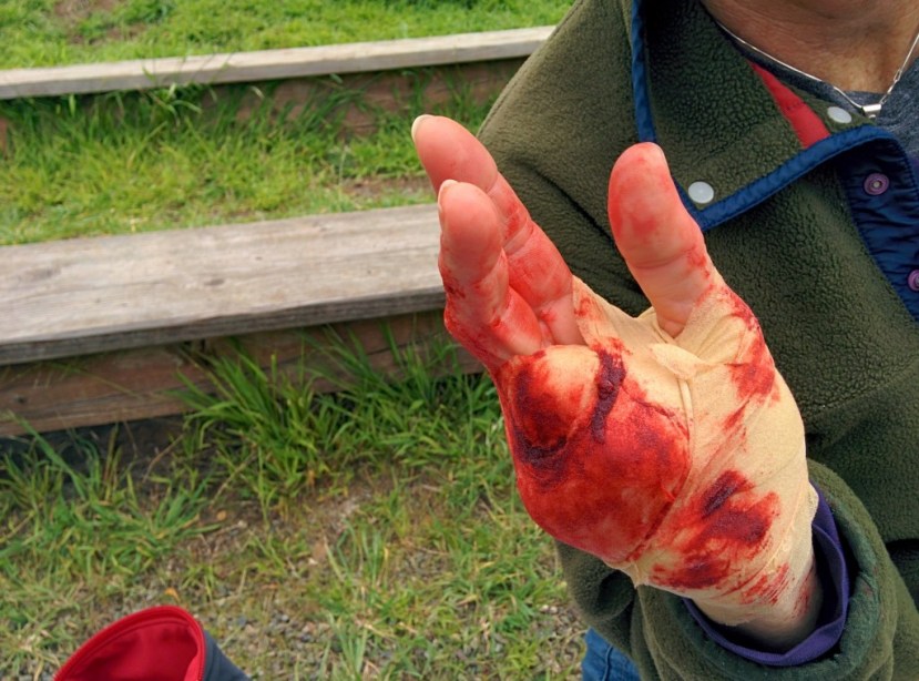 I was incident commander for our large scenario. This woman lost a few fingers after a fall down a cliff. There were six or seven other patients around the scene.